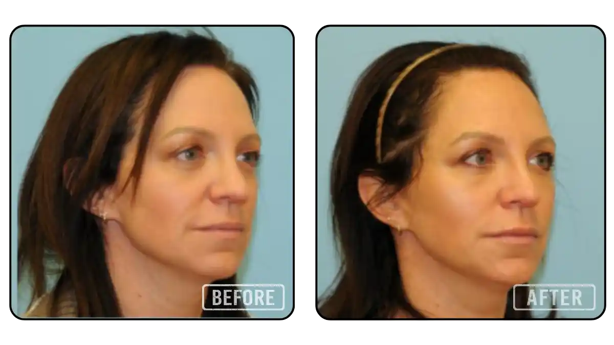 Before and after facial fat grafting showing volume restoration and rejuvenation