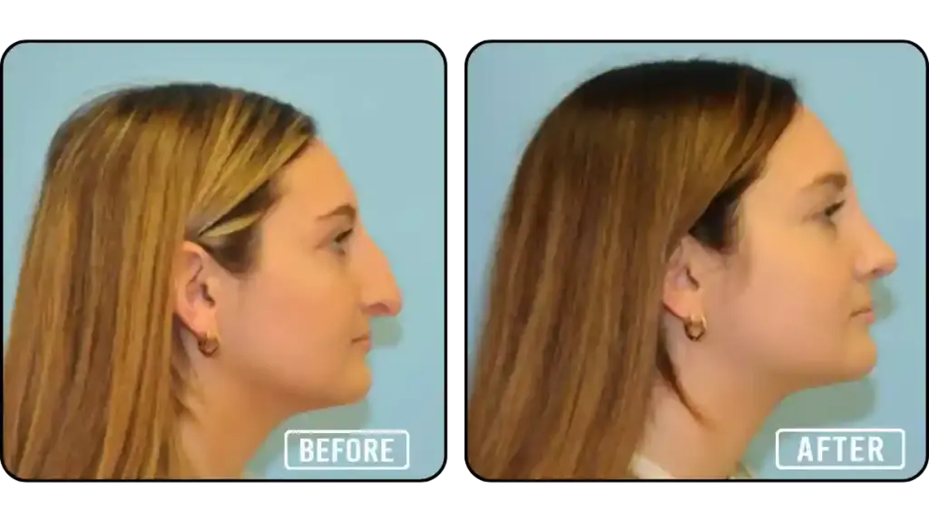 Before and after rhinoplasty results of a young woman performed by Dr. Anthony Berlet, showing enhanced nose contour and facial balance.