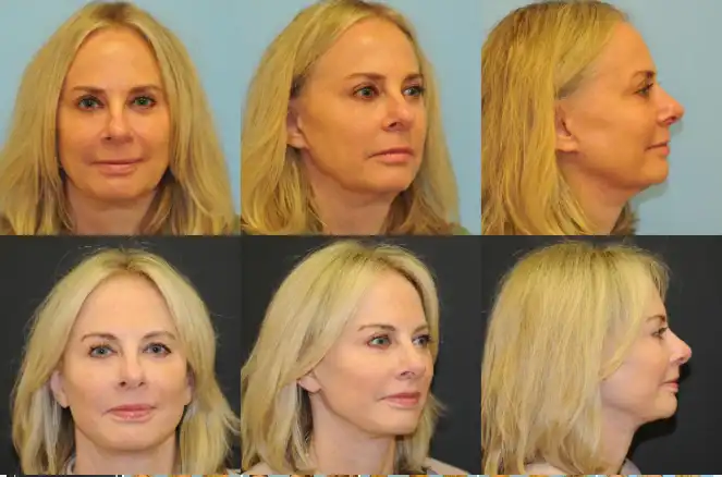 Female Before and after Lip Lift procedure at Berlet Plastic Surgery