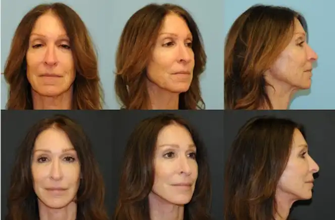 Female Before and after facelift results at Berlet Plastic Surgery