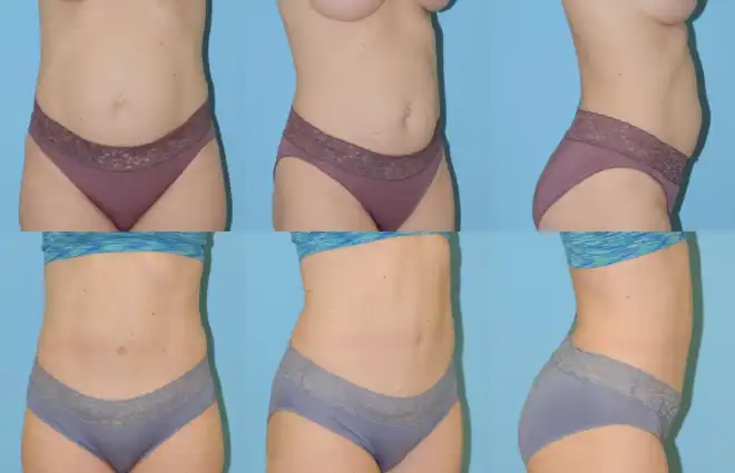 Woman after tummy tuck with flatter abdomen and contoured waist