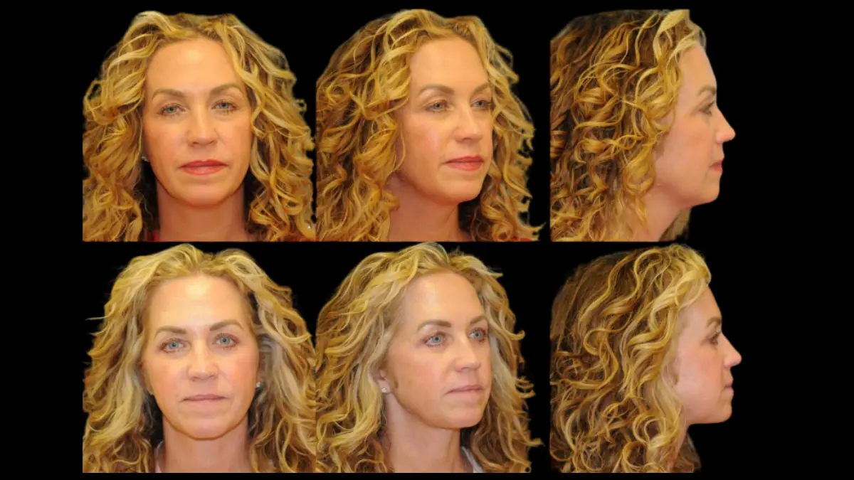 Nice looking women's before and after Berlet Blepharoplasty Surgery