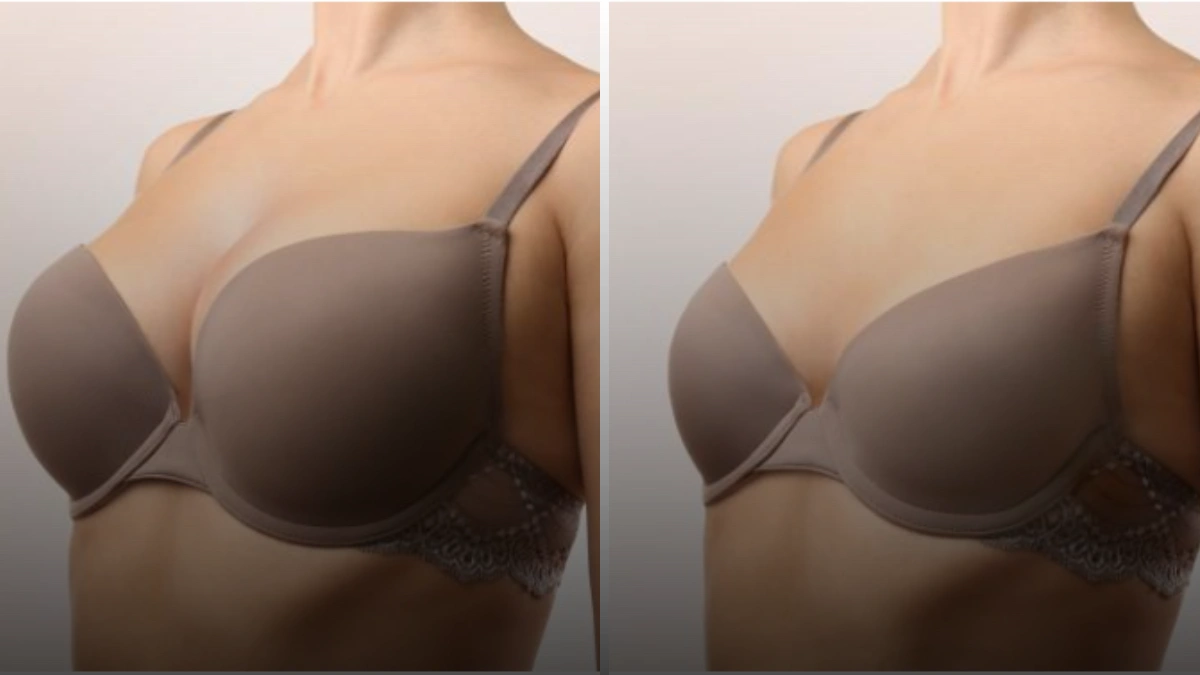 breast reduction mostopexy