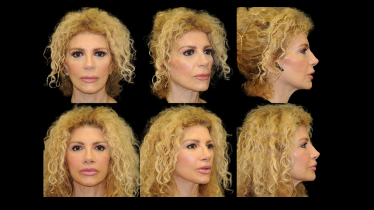Nice looking women before and afer fat grafting servcies at Berlet Plastic Surgery