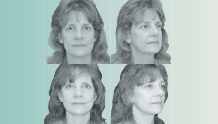 Ozempic Face before and after of Kimberly Bongiorno from Mount Arlington, NJ, showing results of Deep Plane Facelift and Neck Lift performed at Berlet Plastic Surgery.