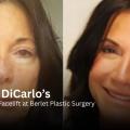 Donna DiCarlo Facelift Featured in People: GLP-1 Transformation at Berlet Plastic Surgery