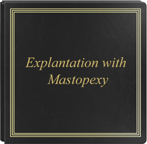 Explantation with Mastopexy