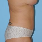 Abdominoplasty Before & After Patient #157