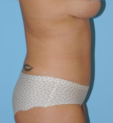 Abdominoplasty Before & After Patient #157