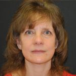 Facelift Before & After Patient #452