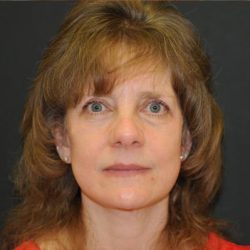 Facelift Before & After Patient #452
