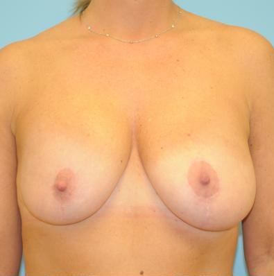 Explanation with Mastopexy Before & After Patient #506