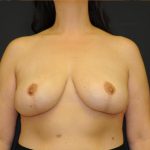 Explanation with Mastopexy Before & After Patient #527