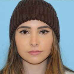 Rhinoplasty Before & After Patient #567