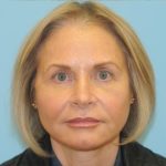 Facelift Before & After Patient #242