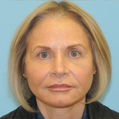 Facelift Before & After Patient #242