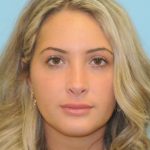 Rhinoplasty Before & After Patient #686