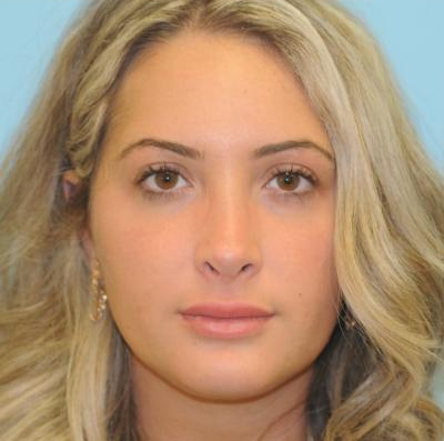 Rhinoplasty Before & After Patient #686