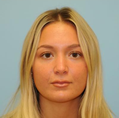 Rhinoplasty Before & After Patient #721