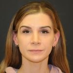 Rhinoplasty Before & After Patient #728