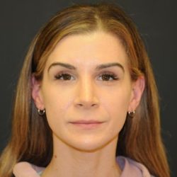 Rhinoplasty Before & After Patient #728