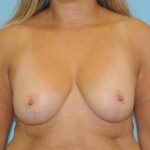 Mastopexy Before & After Patient #804