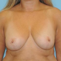 Mastopexy Before & After Patient #804