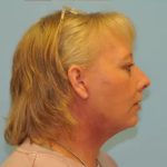Facelift Before & After Patient #256