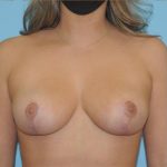 Breast Reduction Before & After Patient #361