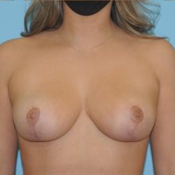 Breast Reduction Before & After Patient #361