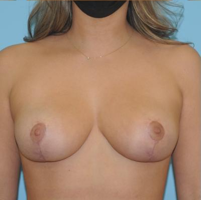 Breast Reduction Before & After Patient #361