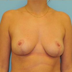Breast Reduction Before & After Patient #368
