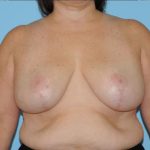 Breast Reduction Before & After Patient #382