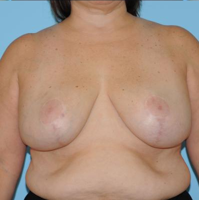 Breast Reduction Before & After Patient #382