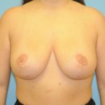 Breast Reduction Before & After Patient #389