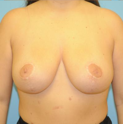 Breast Reduction Before & After Patient #389