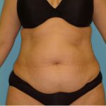 Abdominoplasty Before & After Patient #136