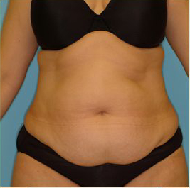 Abdominoplasty Before & After Patient #136