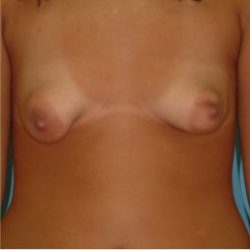 Mastopexy Before & After Patient #777