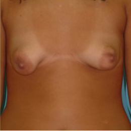 Mastopexy Before & After Patient #777