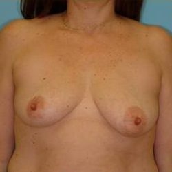Mastopexy Before & After Patient #784