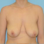 Mastopexy Before & After Patient #791