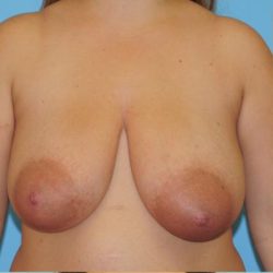 Breast Reduction Before & After Patient #818