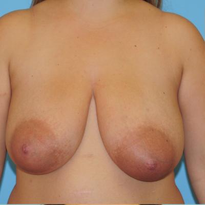Breast Reduction Before & After Patient #818
