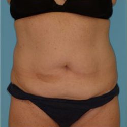 Abdominoplasty Before & After Patient #143