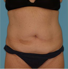 Abdominoplasty Before & After Patient #143