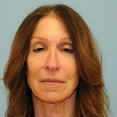 Facelift Before & After Patient #326