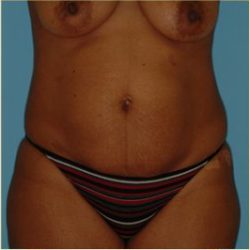 Abdominoplasty Before & After Patient #150