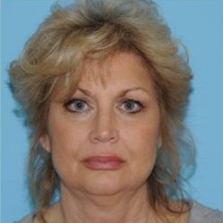Facelift Before & After Patient #171