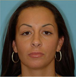 Blepharoplasty Before & After Patient #178